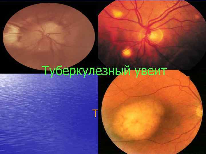 Туберкулезный увеит 