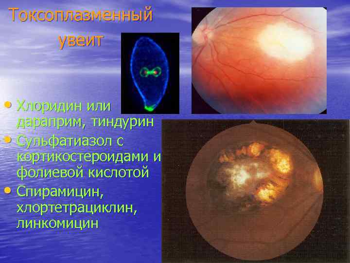 Токсоплазменный увеит • Хлоридин или дараприм, тиндурин • Сульфатиазол с кортикостероидами и фолиевой кислотой