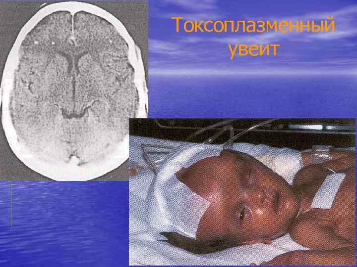 Токсоплазменный увеит 