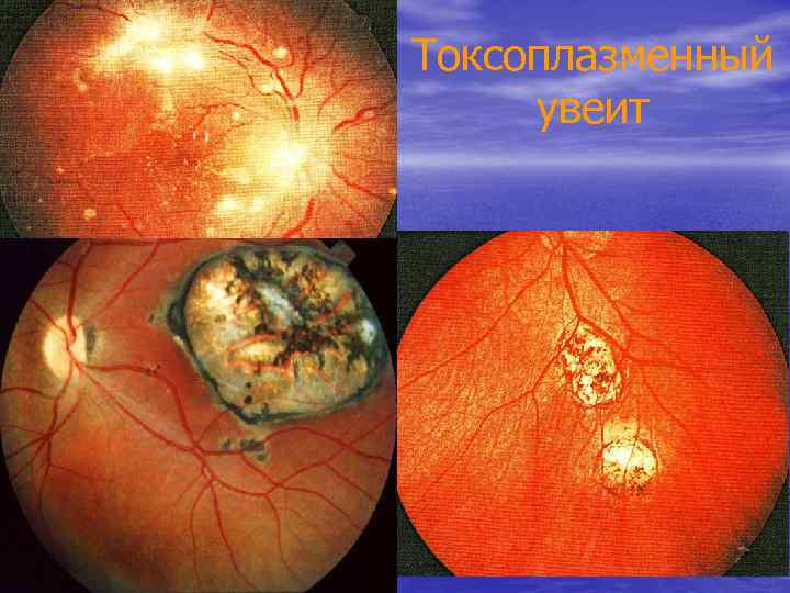 Токсоплазменный увеит 