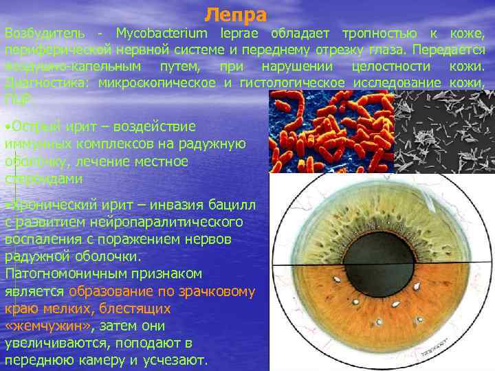 Лепра Возбудитель - Mycobacterium leprae обладает тропностью к коже, периферической нервной системе и переднему