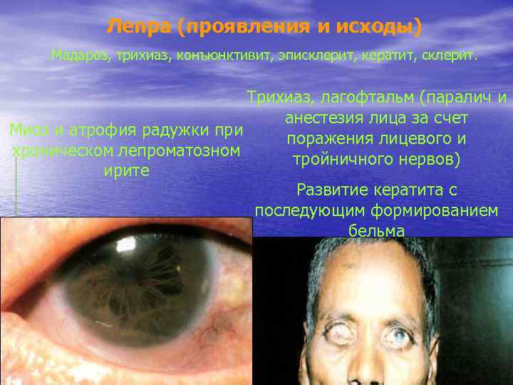 Лепра (проявления и исходы) Мадароз, трихиаз, конъюнктивит, эписклерит, кератит, склерит. Трихиаз, лагофтальм (паралич и