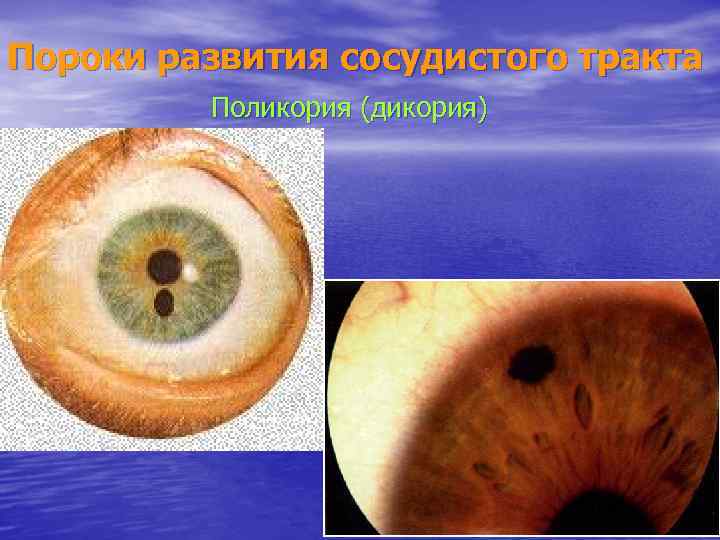 Пороки развития сосудистого тракта Поликория (дикория) 