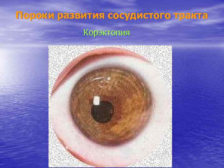 Пороки развития сосудистого тракта Корэктопия 