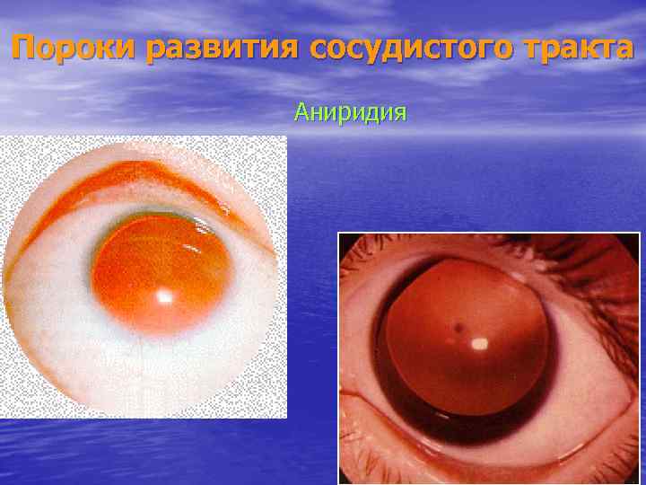 Пороки развития сосудистого тракта Аниридия 