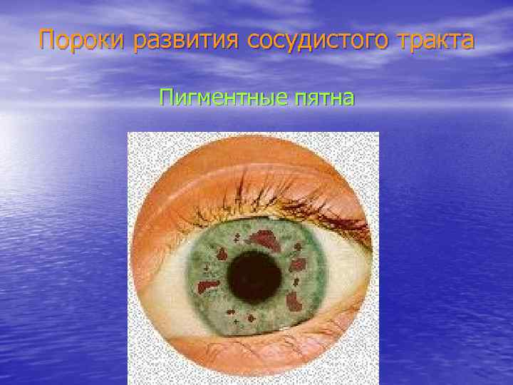 Пороки развития сосудистого тракта Пигментные пятна 