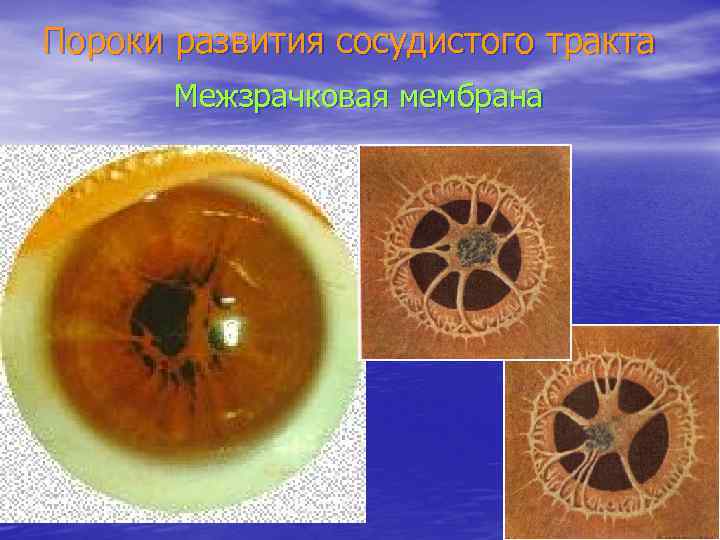 Пороки развития сосудистого тракта Межзрачковая мембрана 