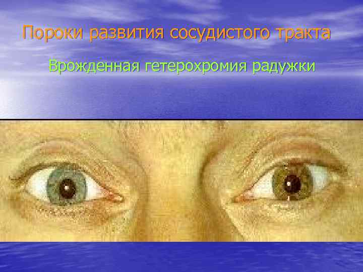 Пороки развития сосудистого тракта Врожденная гетерохромия радужки 