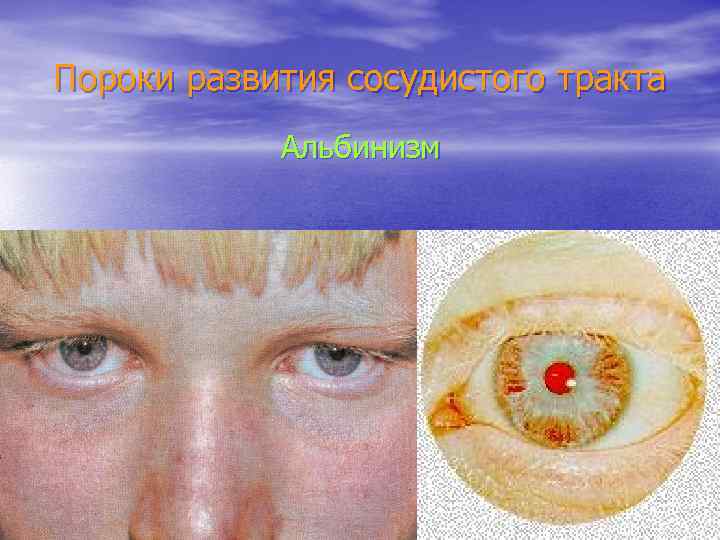 Пороки развития сосудистого тракта Альбинизм 