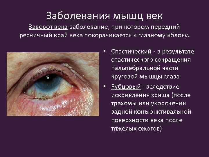 Заболевания мышц век Заворот века-заболевание, при котором передний ресничный край века поворачивается к глазному