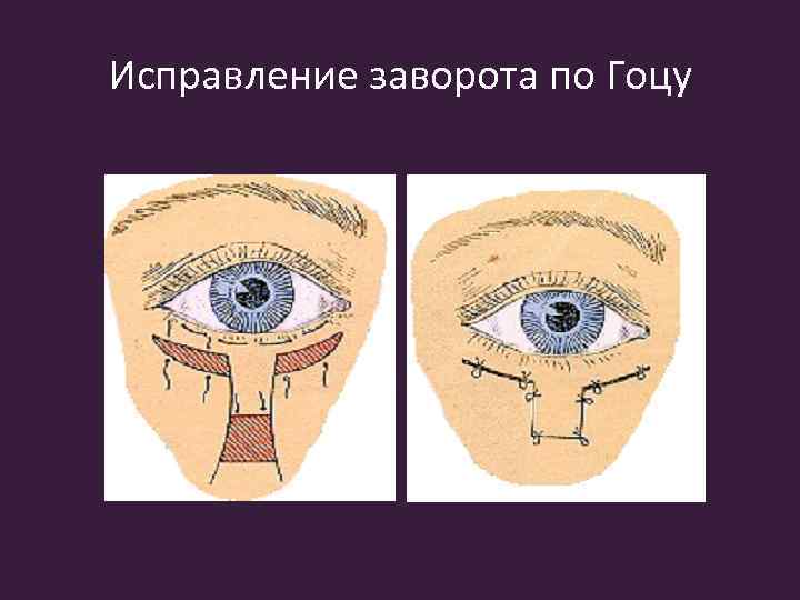 Исправление заворота по Гоцу 