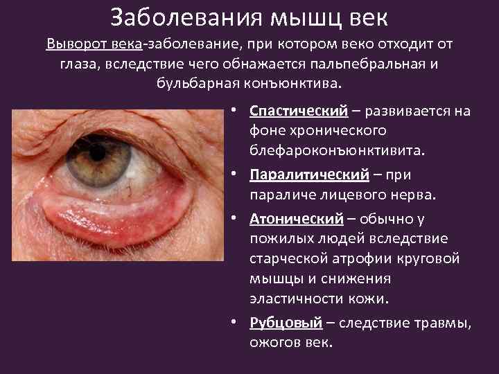 Заболевания мышц век Выворот века-заболевание, при котором веко отходит от глаза, вследствие чего обнажается