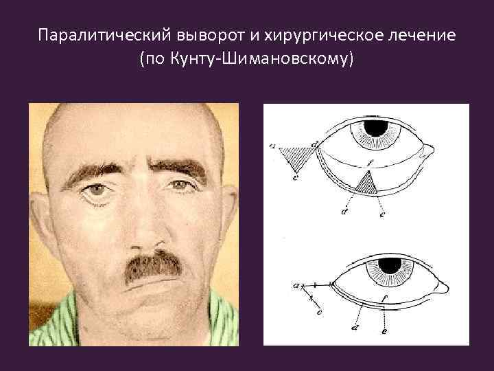 Паралитический выворот и хирургическое лечение (по Кунту-Шимановскому) 