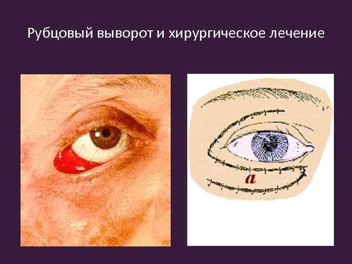 Рубцовый выворот и хирургическое лечение 