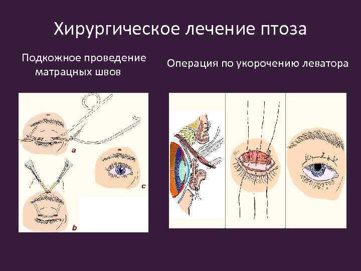 Хирургическое лечение птоза Подкожное проведение матрацных швов Операция по укорочению леватора 