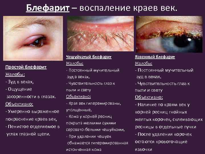 Блефарит – воспаление краев век. Простой блефарит Жалобы: - Зуд в веках, - Ощущение