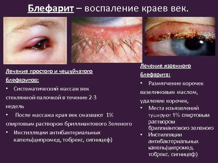 Блефарит – воспаление краев век. Лечение простого и чешуйчатого блефаритов: • Систематический массаж век