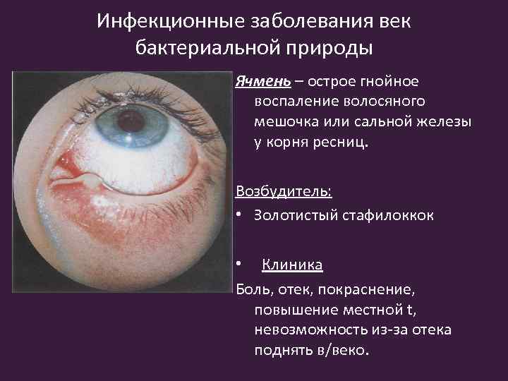 Инфекционные заболевания век бактериальной природы Ячмень – острое гнойное воспаление волосяного мешочка или сальной