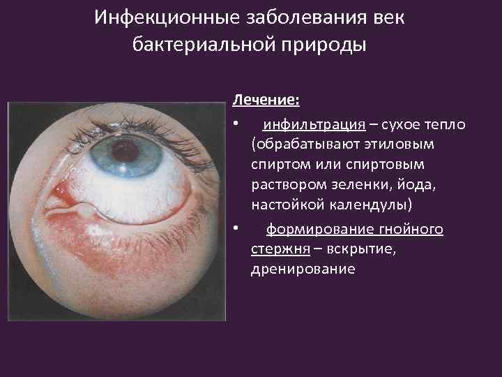 Инфекционные заболевания век бактериальной природы Лечение: • инфильтрация – сухое тепло (обрабатывают этиловым спиртом