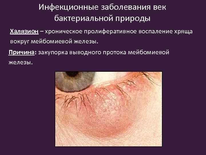 Инфекционные заболевания век бактериальной природы Халязион – хроническое пролиферативное воспаление хряща вокруг мейбомиевой железы.