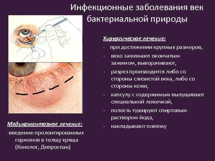 Инфекционные заболевания век бактериальной природы Медикаментозное лечение: -введение пролонгированных гормонов в толщу хряща (Кенолог,