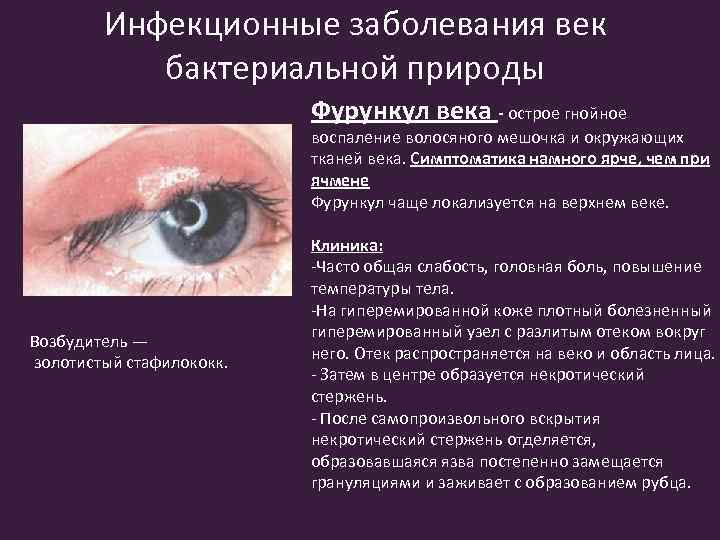 Инфекционные заболевания век бактериальной природы Фурункул века - острое гнойное воспаление волосяного мешочка и