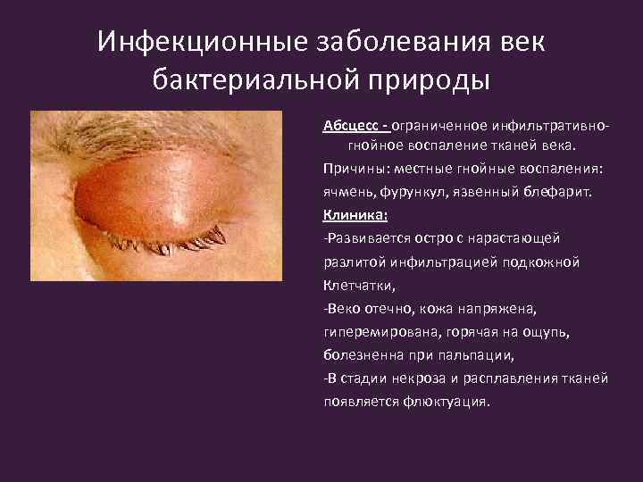 Инфекционные заболевания век бактериальной природы Абсцесс - ограниченное инфильтративногнойное воспаление тканей века. Причины: местные