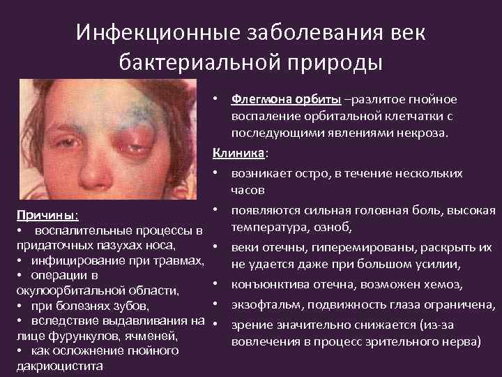 Инфекционные заболевания век бактериальной природы • Флегмона орбиты –разлитое гнойное воспаление орбитальной клетчатки с