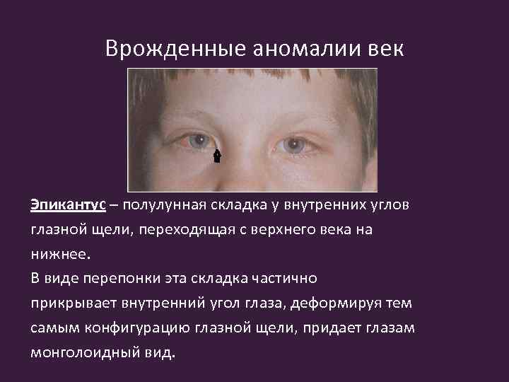 Врожденные аномалии век Эпикантус – полулунная складка у внутренних углов глазной щели, переходящая с