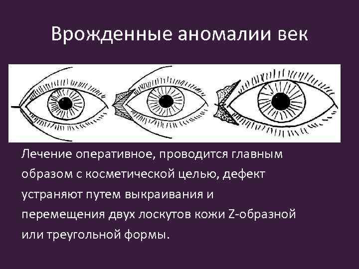 Врожденные аномалии век Лечение оперативное, проводится главным образом с косметической целью, дефект устраняют путем