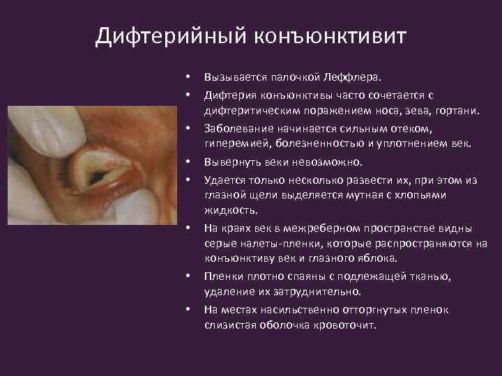 Дифтерийный конъюнктивит • • Вызывается палочкой Леффлера. Дифтерия конъюнктивы часто сочетается с дифтеритическим поражением