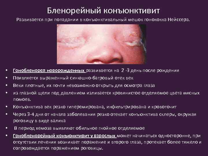 Бленорейный конъюнктивит Развивается при попадании в конъюнктивальный мешок гонококка Нейссера. • • Гонобленорея новорожденных