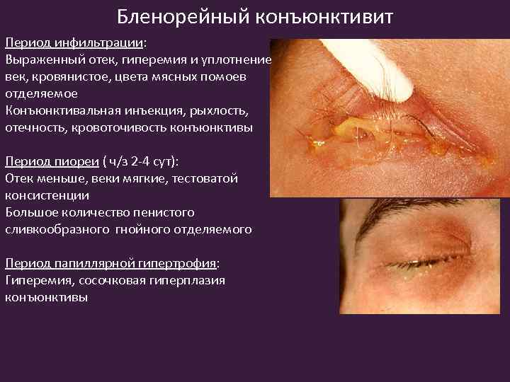 Бленорейный конъюнктивит Период инфильтрации: Выраженный отек, гиперемия и уплотнение век, кровянистое, цвета мясных помоев