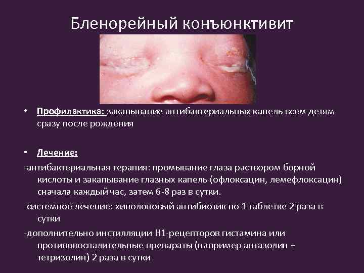 Бленорейный конъюнктивит • Профилактика: закапывание антибактериальных капель всем детям сразу после рождения • Лечение: