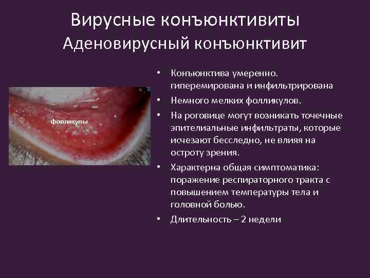 Вирусные конъюнктивиты Аденовирусный конъюнктивит фолликулы • Конъюнктива умеренно. гиперемирована и инфильтрирована • Немного мелких