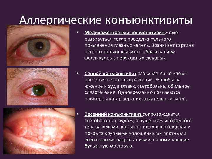 Аллергические конъюнктивиты • Медикаментозный конъюнктивит может развиваться после продолжительного применения глазных капель. Возникает картина