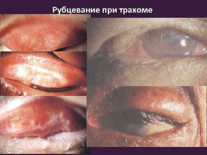 Рубцевание при трахоме 
