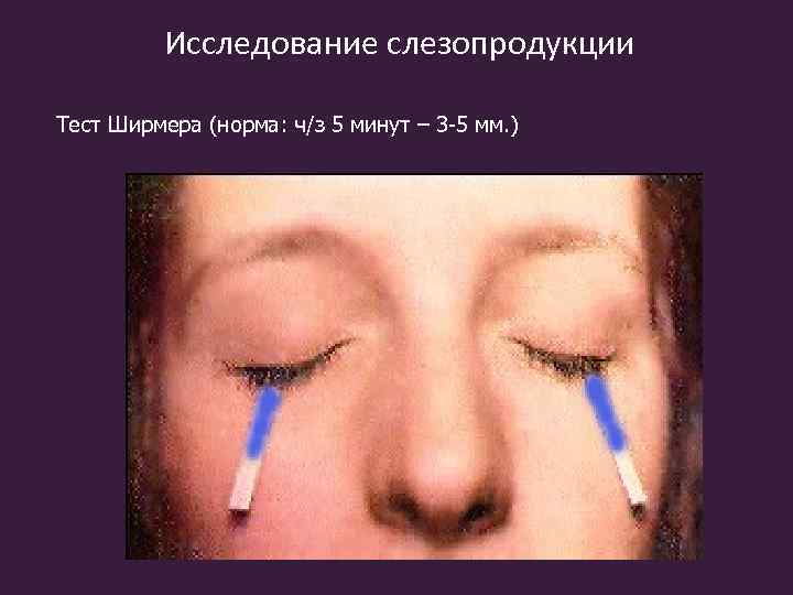 Исследование слезопродукции Тест Ширмера (норма: ч/з 5 минут – 3 -5 мм. ) 
