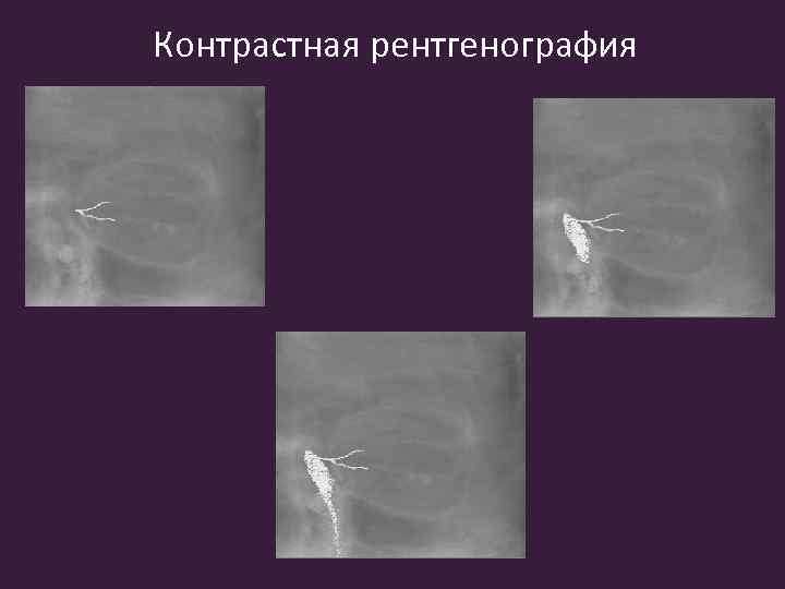 Контрастная рентгенография 