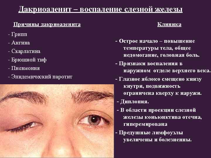 Дакриоаденит – воспаление слезной железы Причины дакриоаденита - Грипп - Ангина - Скарлатина -