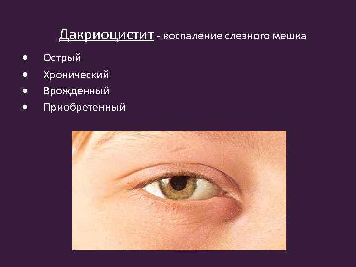 Дакриоцистит - воспаление слезного мешка Острый Хронический Врожденный Приобретенный 
