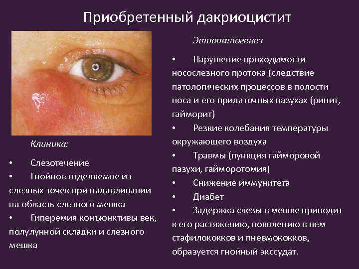 Приобретенный дакриоцистит Этиопатогенез Клиника: • Слезотечение • Гнойное отделяемое из слезных точек при надавливании