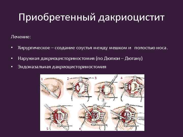 Приобретенный дакриоцистит Лечение: • Хирургическое – создание соустья между мешком и полостью носа. •