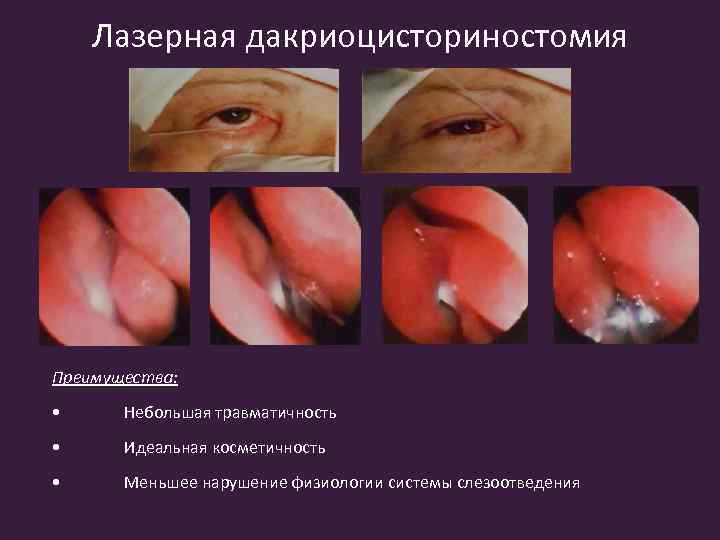 Лазерная дакриоцисториностомия Преимущества: • Небольшая травматичность • Идеальная косметичность • Меньшее нарушение физиологии системы