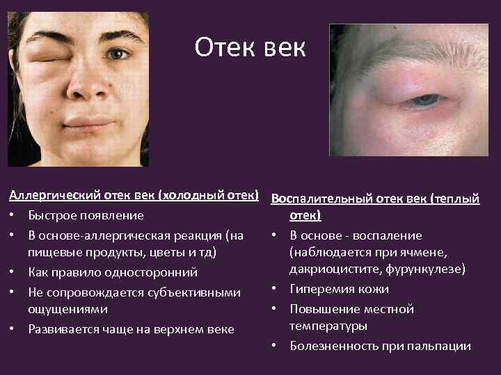 Отек век Аллергический отек век (холодный отек) • Быстрое появление • В основе-аллергическая реакция