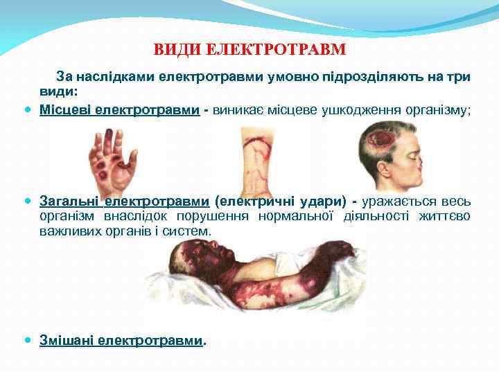 ВИДИ ЕЛЕКТРОТРАВМ За наслідками електротравми умовно підрозділяють на три види: Місцеві електротравми - виникає