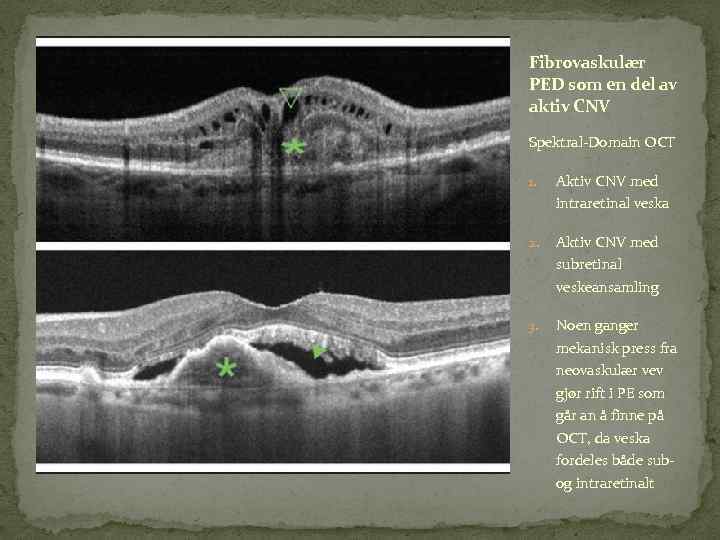 Fibrovaskulær PED som en del av aktiv CNV Spektral-Domain OCT 1. Aktiv CNV med
