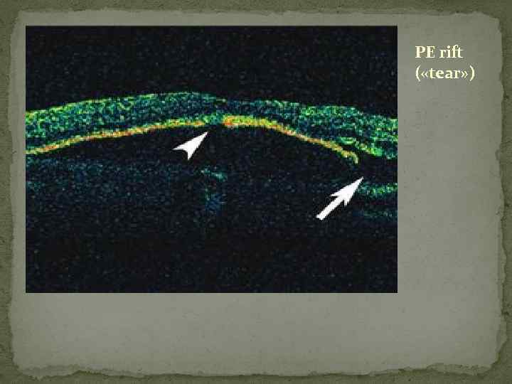 PE rift ( «tear» ) 