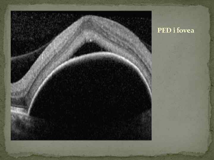 PED i fovea 