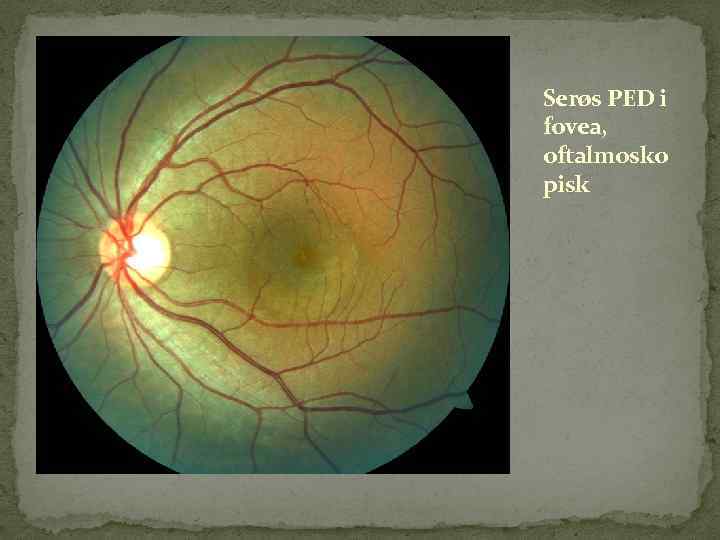 Serøs PED i fovea, oftalmosko pisk 